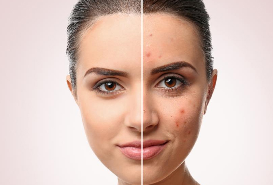 Customized acne scar removal and skincare treatments Kochi