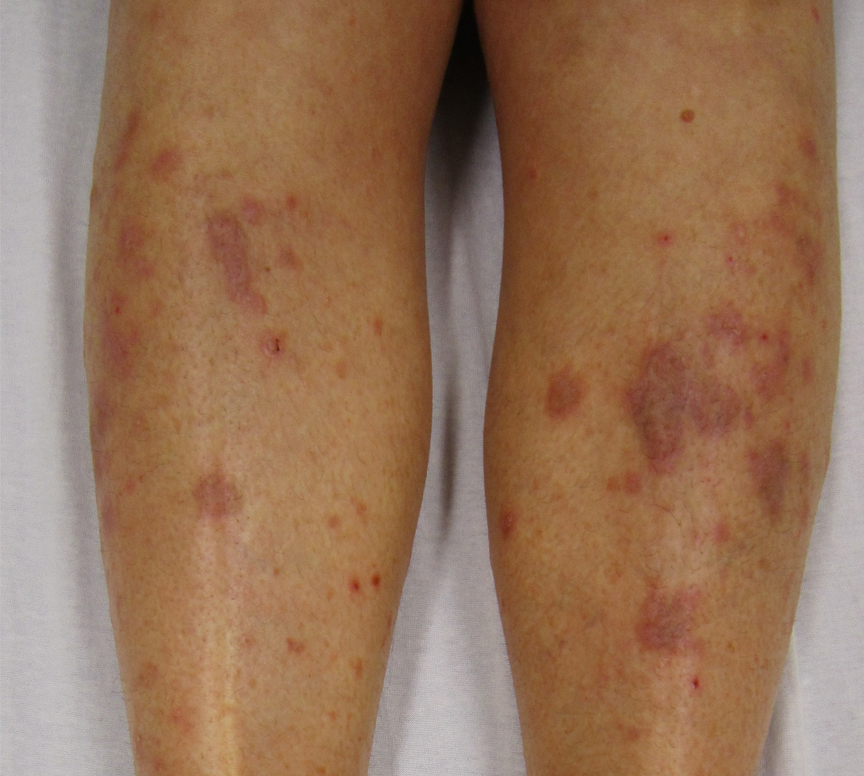 Dermatologist examining patient with lichen planus on arms