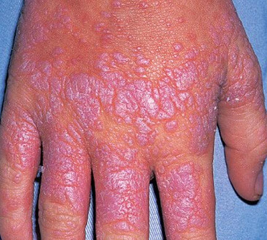 Professional treatment for lichen planus at skin clinic in Kochi