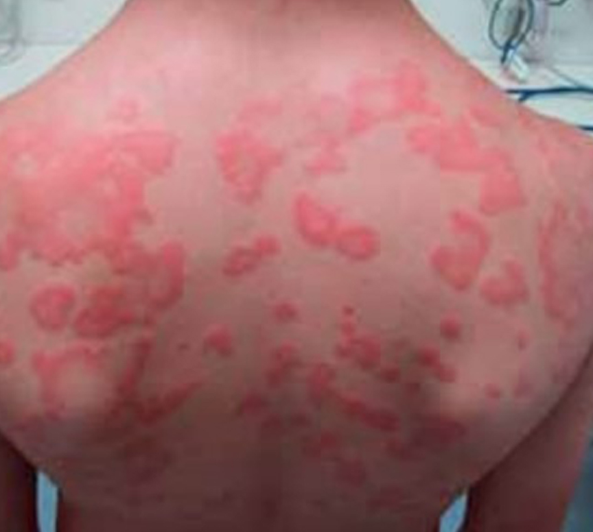 Dermatologist diagnosing chronic urticaria and skin allergies