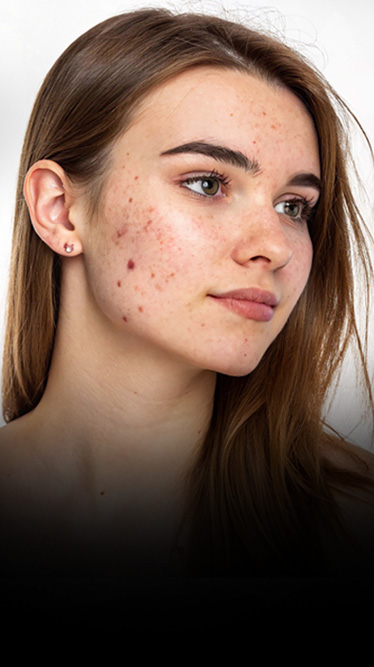Best dermatologist in Kochi for acne and pimple treatment