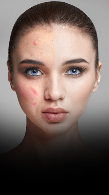 Reduced acne scarring through early dermatological treatment