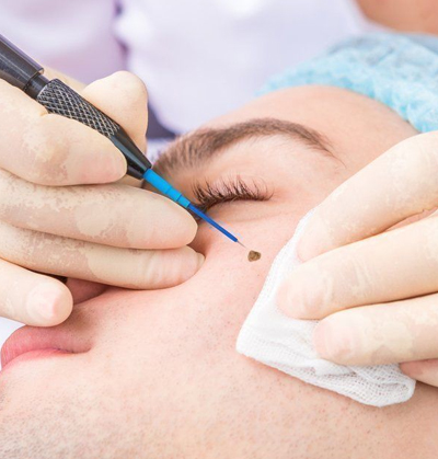 Comprehensive dermatosurgery care for scar revision and keloid removal