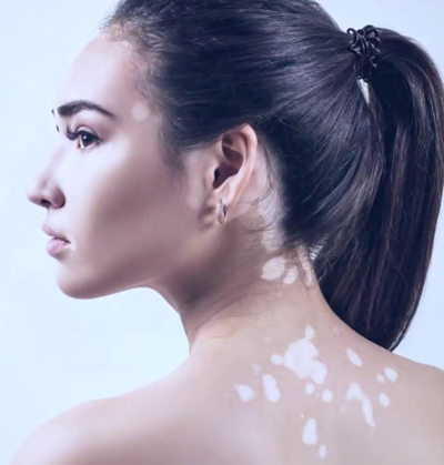 Advanced vitiligo surgical treatment for restoring natural skin color