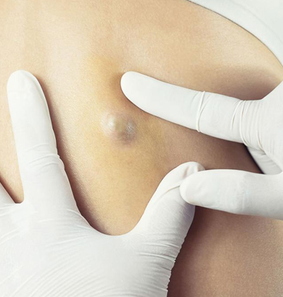 Dermatologist performing lipoma and cyst removal surgery at Skinpal Clinic Kochi