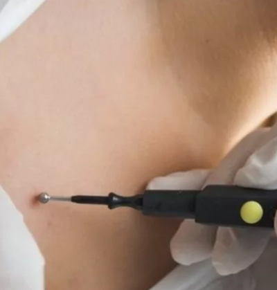 Expert applying chemical cautery for wart and skin tag removal in Kochi