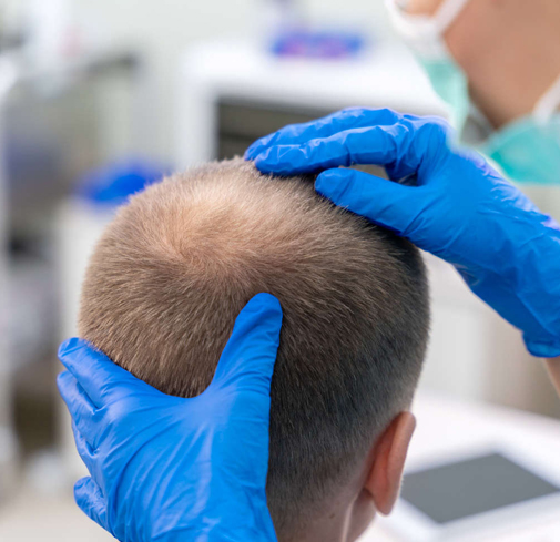 Exosome treatment for hair regrowth and scalp revitalization in Kochi