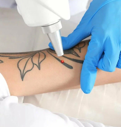 Patient undergoing safe and effective laser tattoo removal treatment