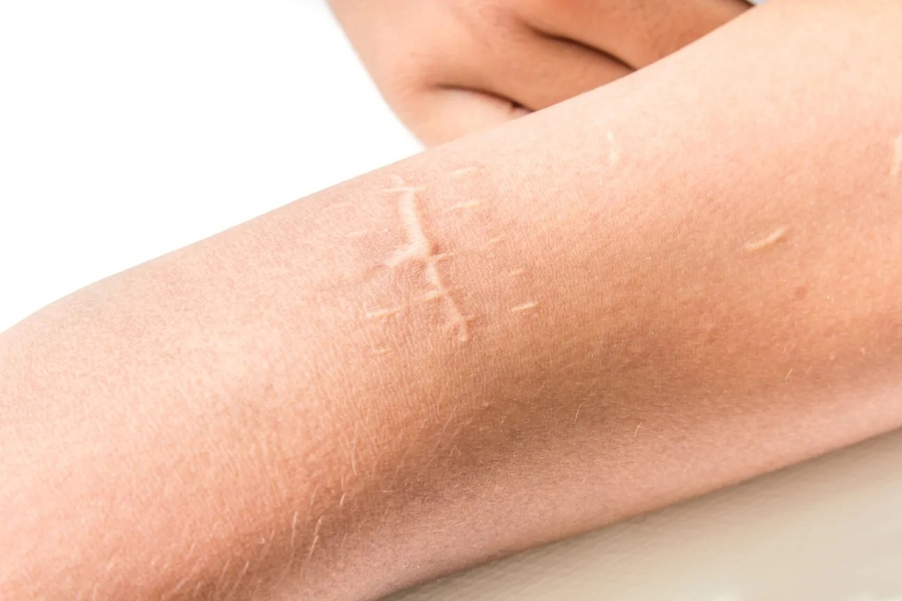 Treatment to minimize raised and irregular scars through surgery