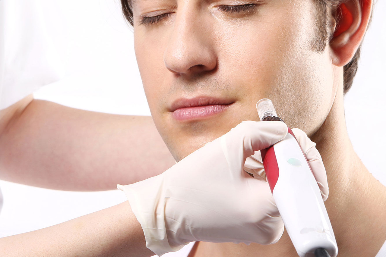 Microneedling procedure to improve skin texture and reduce scars
