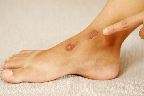 Laser treatment for flattening and fading keloid scars