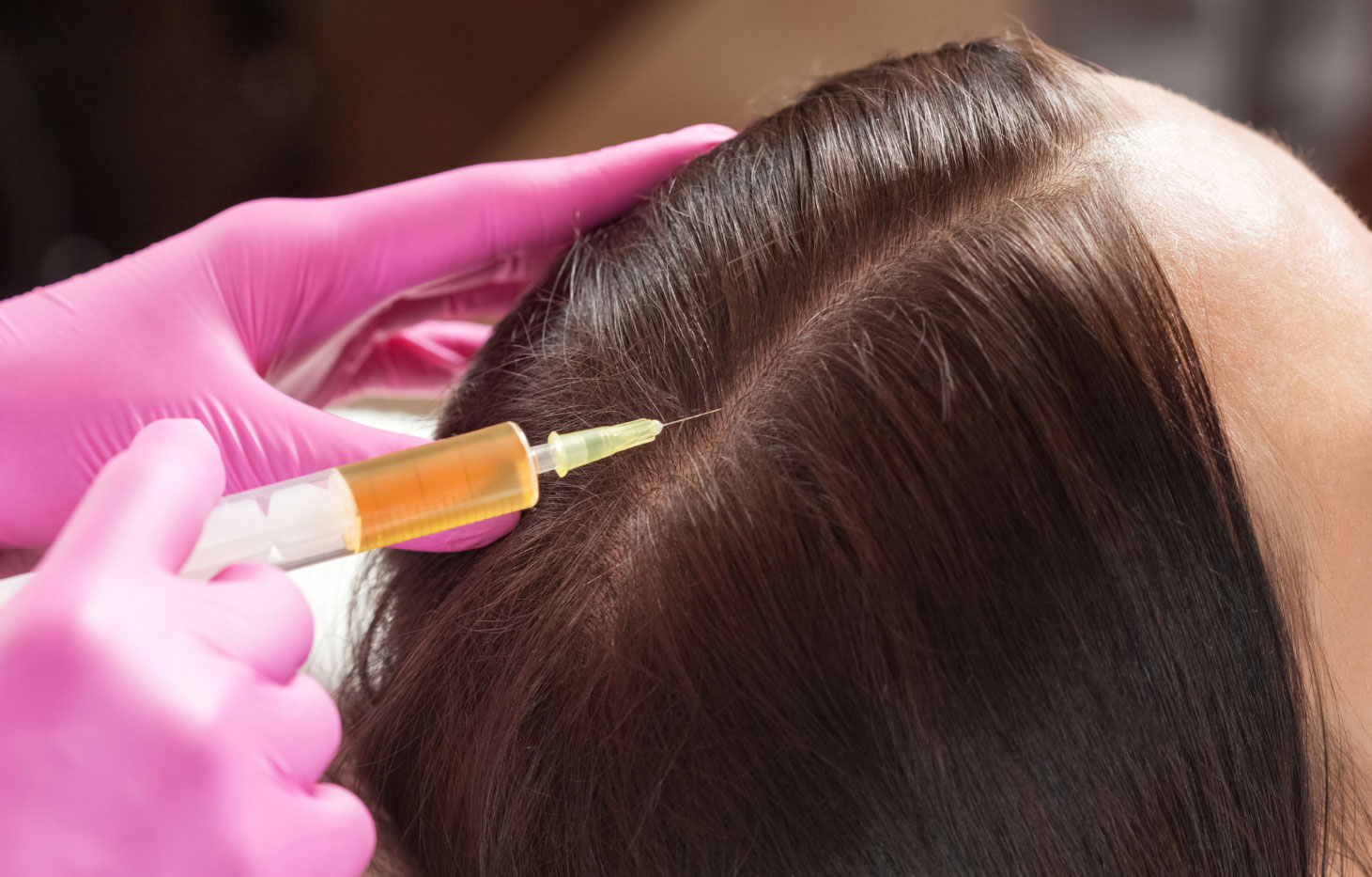 Dermatologist performing advanced hair loss treatment in Kochi