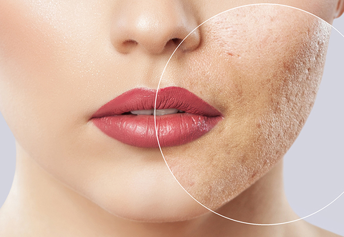 Microneedling and subcision treatment for deep acne scars