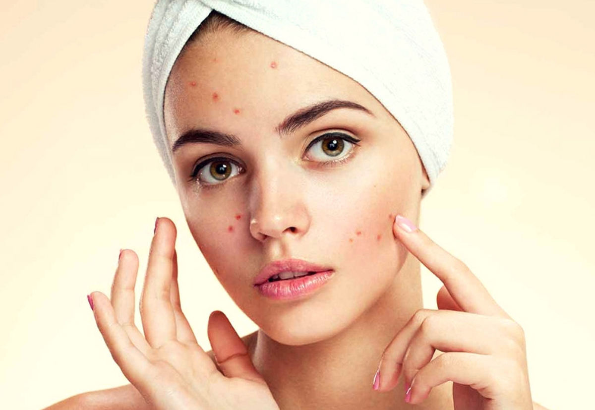 Blue light therapy and medication for active acne management